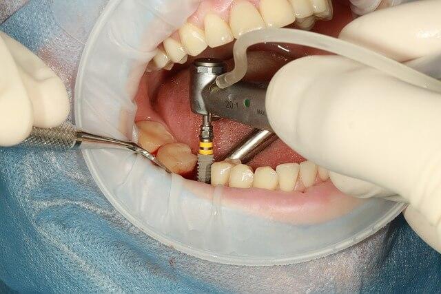 A dental implant being placed during treatment, shown under isolation