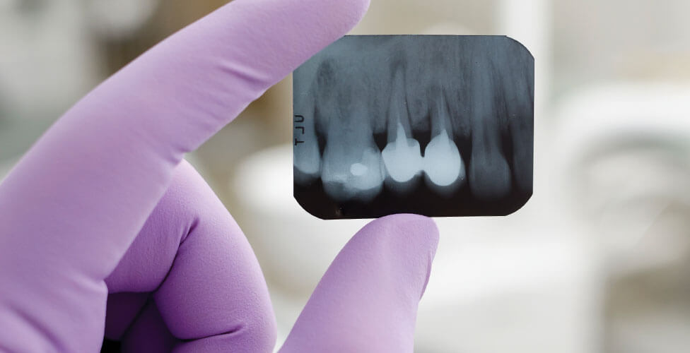 A dental X-ray showing restored teeth, held in a gloved hand